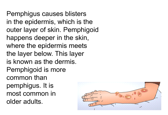 Pemphigus causes blisters in the epidermis, which is the outer layer of skin. Pemphigoid happens deeper in the skin, where the epidermis meets the layer below. This layer is known as the dermis. Pemphigoid is more common than pemphigus. It is most common in older adults.