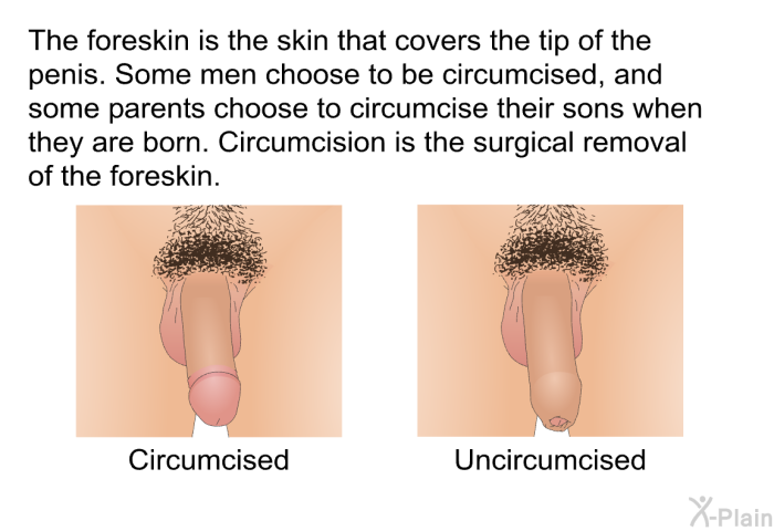 The foreskin is the skin that covers the tip of the penis. Some men choose to be circumcised, and some parents choose to circumcise their sons when they are born. Circumcision is the surgical removal of the foreskin.