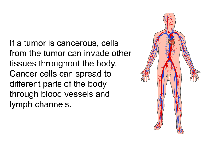 If a tumor is cancerous, cells from the tumor can invade other tissues throughout the body. Cancer cells can spread to different parts of the body through blood vessels and lymph channels.