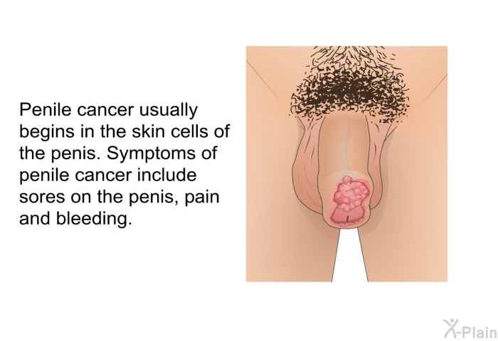 Penile cancer usually begins in the skin cells of the penis. Symptoms of penile cancer include sores on the penis, pain and bleeding.