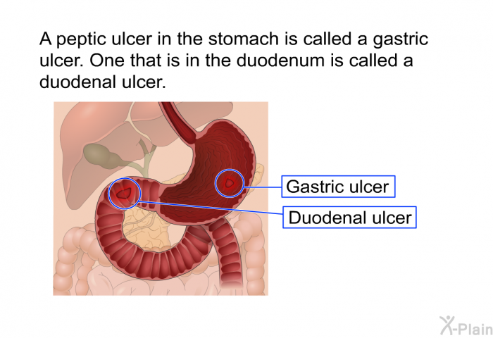 A peptic ulcer in the stomach is called a gastric ulcer. One that is in the duodenum is called a duodenal ulcer.