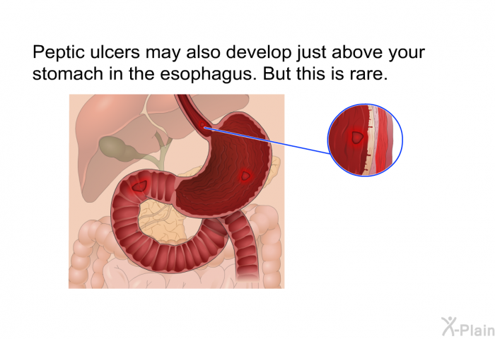 Peptic ulcers may also develop just above your stomach in the esophagus. But this is rare.