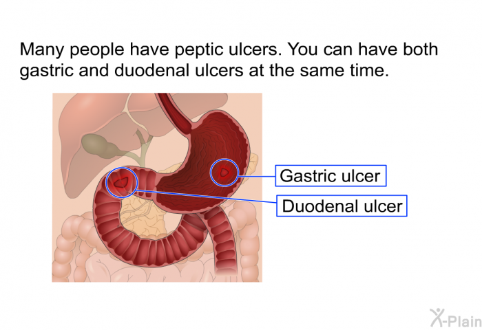 Many people have peptic ulcers. You can have both gastric and duodenal ulcers at the same time.