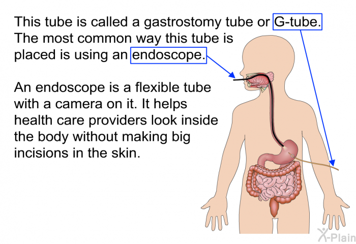 This tube is called a gastrostomy tube or G-tube. The most common way this tube is placed is using an endoscope. An endoscope is a flexible tube with a camera on it. It helps health care providers look inside the body without making big incisions in the skin.