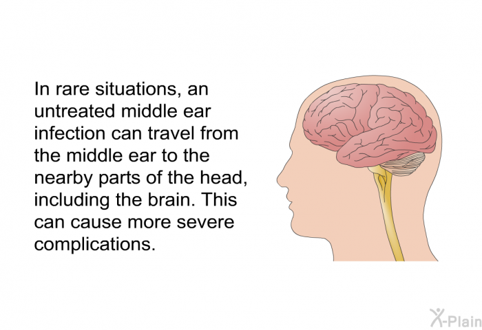 In rare situations, an untreated middle ear infection can travel from the middle ear to the nearby parts of the head, including the brain. This can cause more severe complications.