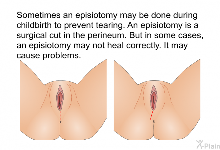 Sometimes an episiotomy may be done during childbirth to prevent tearing. An episiotomy is a surgical cut in the perineum. But in some cases, an episiotomy may not heal correctly. It may cause problems.