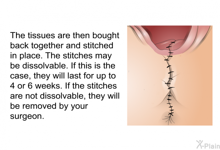 The tissues are then bought back together and stitched in place. The stitches may be dissolvable. If this is the case, they will last for up to 4 or 6 weeks. If the stitches are not dissolvable, they will be removed by your surgeon.