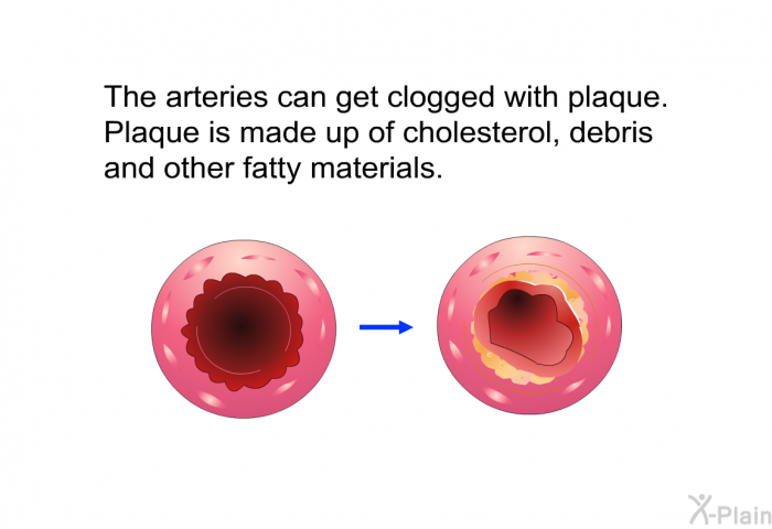 The arteries can get clogged with plaque. Plaque is made up of cholesterol, debris and other fatty materials.