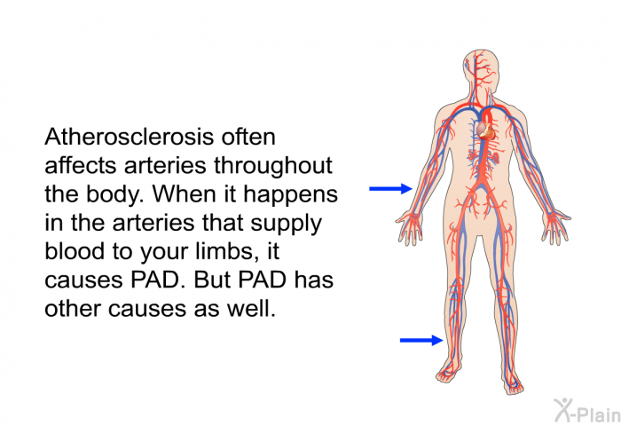 Atherosclerosis often affects arteries throughout the body. When it happens in the arteries that supply blood to your limbs, it causes PAD. But PAD has other causes as well.