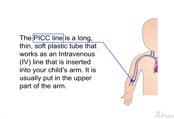 The PICC line is a long, thin, soft plastic tube that works as an Intravenous (IV) line that is inserted into your child's arm. It is usually put in the upper part of the arm.