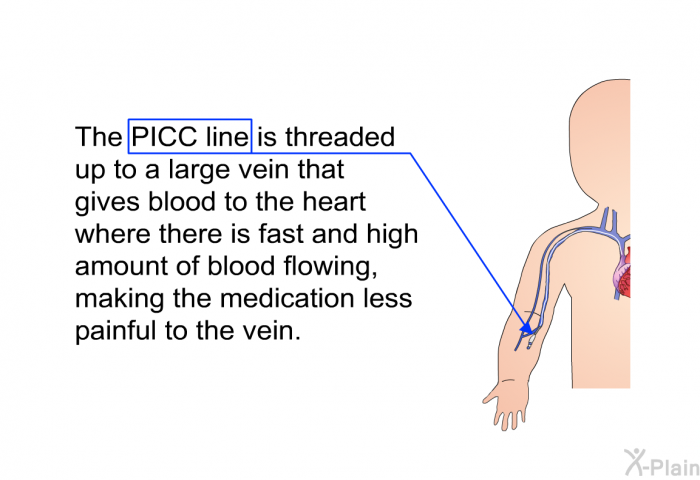 The PICC line is threaded up to a large vein that gives blood to the heart where there is fast and high amount of blood flowing, making the medication less painful to the vein.