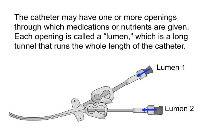 The catheter may have one or more openings through which medications or nutrients are given. Each opening is called a “lumen,” which is a long tunnel that runs the whole length of the catheter.