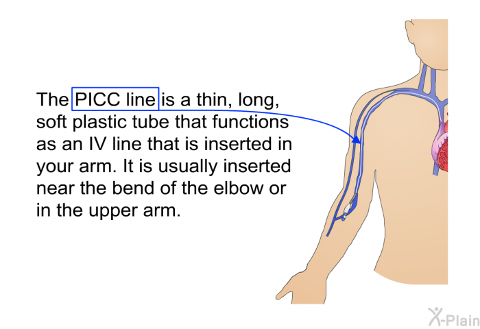 The PICC line is a thin, long, soft plastic tube that functions as an IV line that is inserted in your arm. It is usually inserted near the bend of the elbow or in the upper arm.