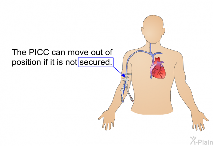 The PICC can move out of position if it is not secured.