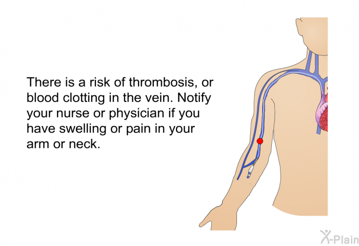 There is a risk of thrombosis, or blood clotting in the vein. Notify your nurse or physician if you have swelling or pain in your arm or neck.