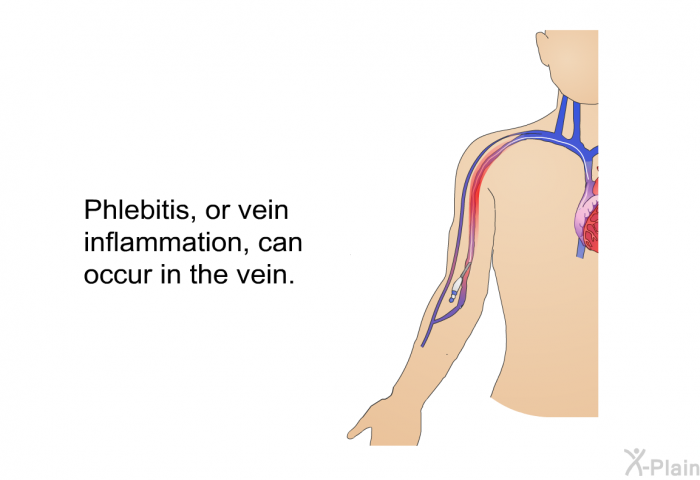 Phlebitis, or vein inflammation, can occur in the vein.