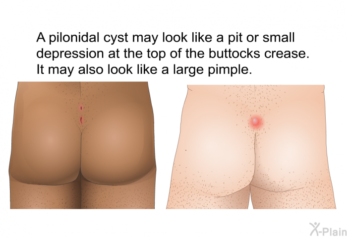 A pilonidal cyst may look like a pit or small depression at the top of the buttocks crease. It may also look like a large pimple.