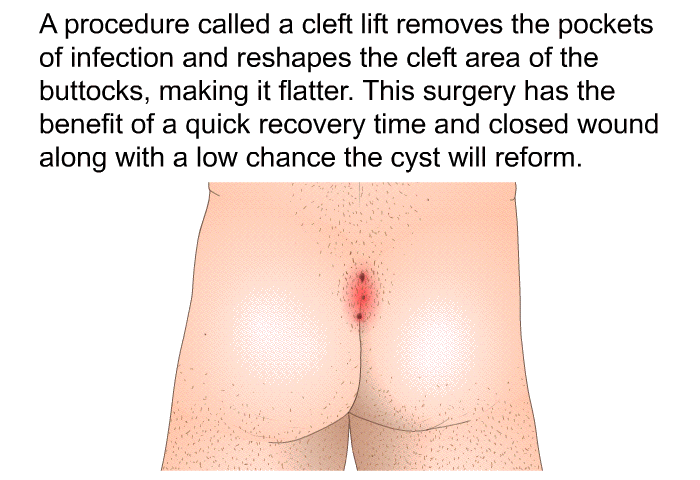 A procedure called a cleft lift removes the pockets of infection and reshapes the cleft area of the buttocks, making it flatter. This surgery has the benefit of a quick recovery time and closed wound along with a low chance the cyst will reform.