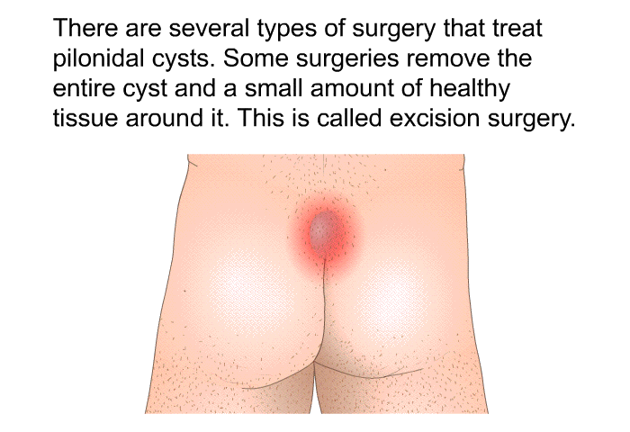 There are several types of surgery that treat pilonidal cysts. Some surgeries remove the entire cyst and a small amount of healthy tissue around it. This is called excision surgery.