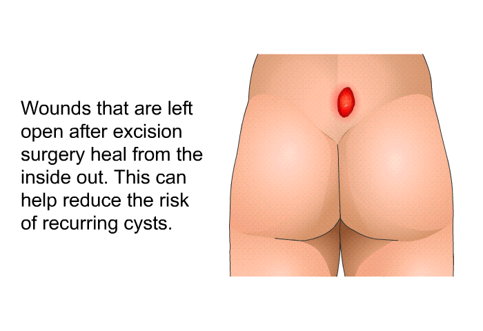 Wounds that are left open after excision surgery heal from the inside out. This can help reduce the risk of recurring cysts.