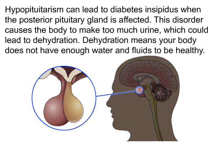 Hypopituitarism can lead to diabetes insipidus when the posterior pituitary gland is affected. This disorder causes the body to make too much urine, which could lead to dehydration. Dehydration means your body does not have enough water and fluids to be healthy.