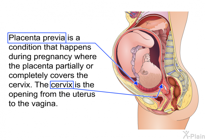 Placenta previa is a condition that happens during pregnancy where the placenta partially or completely covers the cervix. The cervix is the opening from the uterus to the vagina.