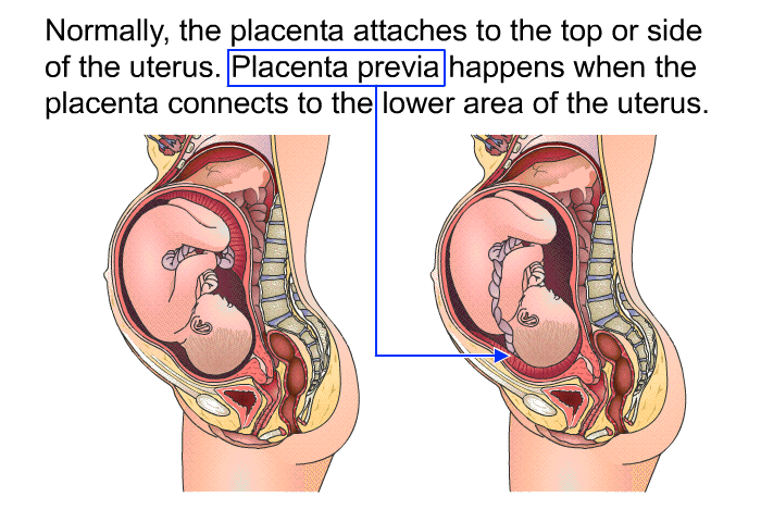 Normally, the placenta attaches to the top or side of the uterus. Placenta previa happens when the placenta connects to the lower area of the uterus.