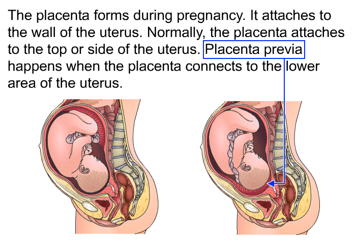 The placenta forms during pregnancy. It attaches to the wall of the uterus. Normally, the placenta attaches to the top or side of the uterus. Placenta previa happens when the placenta connects to the lower area of the uterus.