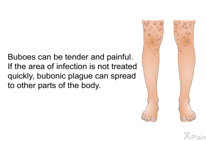Buboes can be tender and painful. If the area of infection is not treated quickly, bubonic plague can spread to other parts of the body.