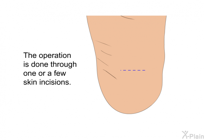 The operation is done through one or a few skin incisions.