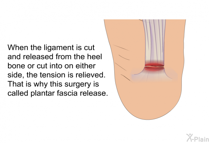 When the ligament is cut and released from the heel bone or cut into on either side, the tension is relieved. That is why this surgery is called plantar fascia release.