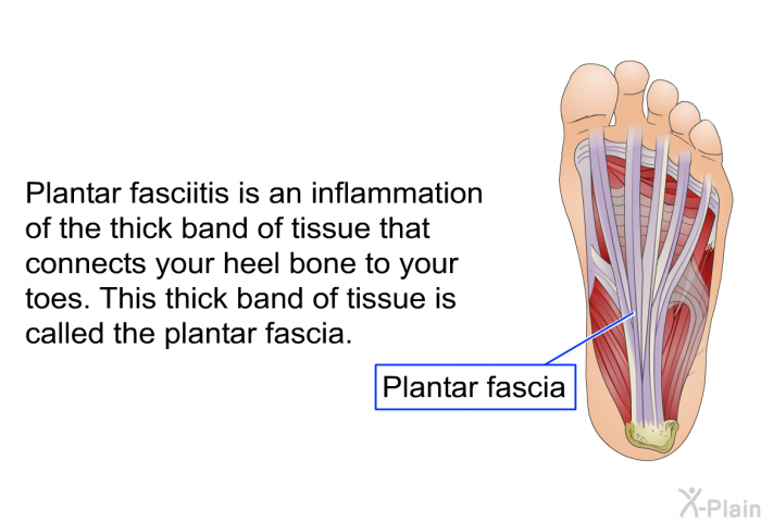 Plantar fasciitis is an inflammation of the thick band of tissue that connects your heel bone to your toes. This thick band of tissue is called the plantar fascia.