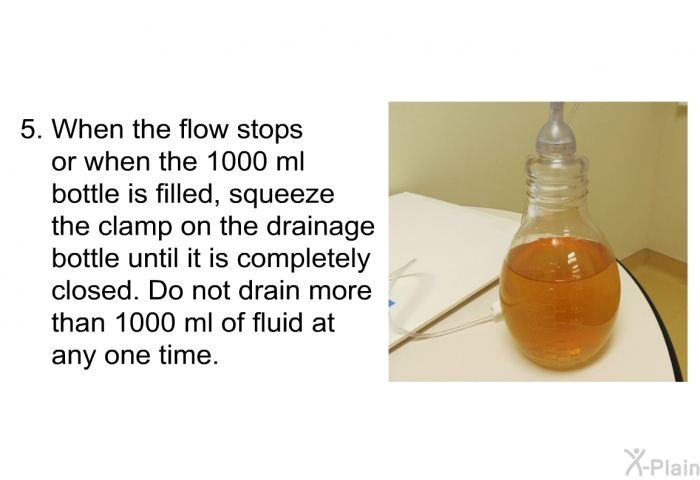When the flow stops or when the 1000 ml bottle is filled, squeeze the clamp on the drainage bottle until it is completely closed. Do not drain more than 1000 ml of fluid at any one time.