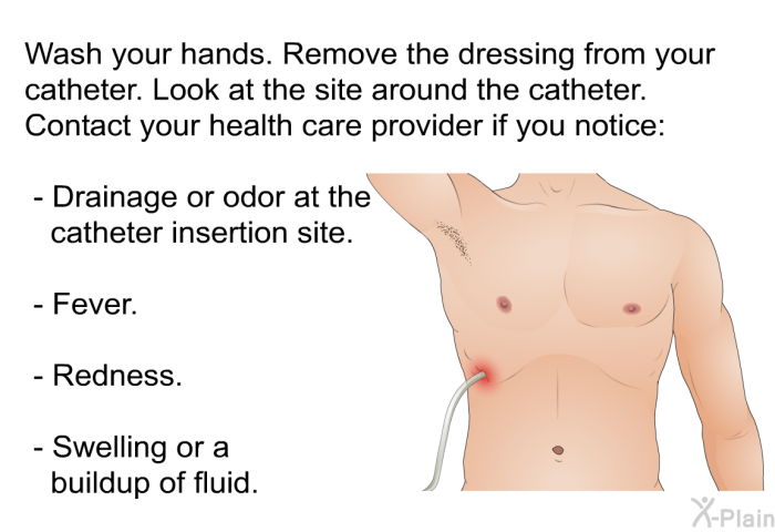 Wash your hands. Remove the dressing from your catheter. Look at the site around the catheter. Contact your health care provider if you notice:  Drainage or odor at the catheter insertion site. Fever. Redness. Swelling or a buildup of fluid.
