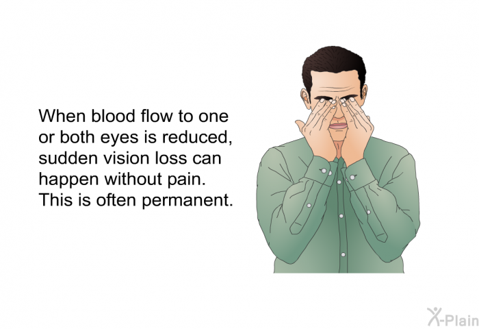 When blood flow to one or both eyes is reduced, sudden vision loss can happen without pain. This is often permanent.