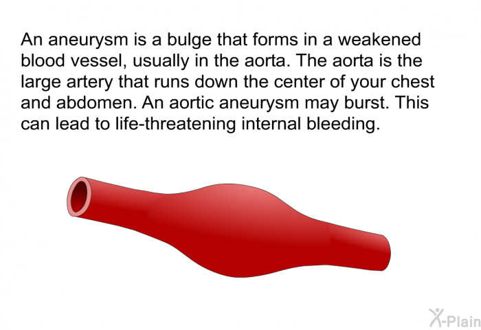 An aneurysm is a bulge that forms in a weakened blood vessel, usually in the aorta. The aorta is the large artery that runs down the center of your chest and abdomen. An aortic aneurysm may burst. This can lead to life-threatening internal bleeding.