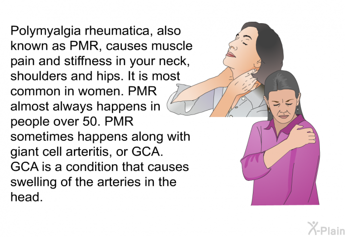 Polymyalgia rheumatica, also known as PMR, causes muscle pain and stiffness in your neck, shoulders and hips. It is most common in women. PMR almost always happens in people over 50. PMR sometimes happens along with giant cell arteritis, or GCA. GCA is a condition that causes swelling of the arteries in the head.