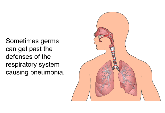 Sometimes germs can get past the defenses of the respiratory system causing pneumonia.