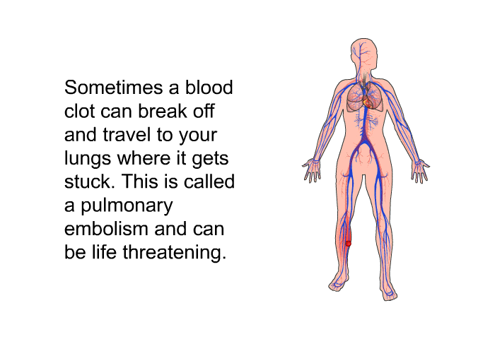 Sometimes a blood clot can break off and travel to your lungs where it gets stuck. This is called a pulmonary embolism and can be life threatening.