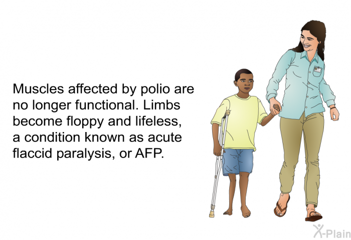 Muscles affected by polio are no longer functional. Limbs become floppy and lifeless, a condition known as acute flaccid paralysis, or AFP.