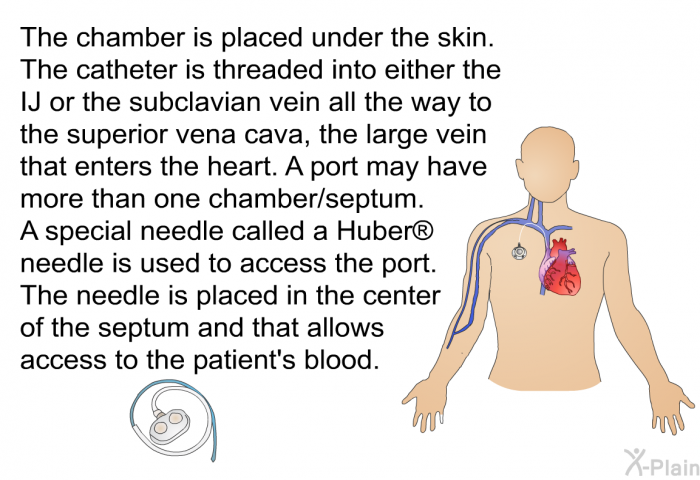 The chamber is placed under the skin. The catheter is threaded into either the IJ or the subclavian vein all the way to the superior vena cava, the large vein that enters the heart. A port may have more than one chamber/septum. A special needle called a Huber  needle is used to access the port. The needle is placed in the center of the septum and that allows access to the patient’s blood.