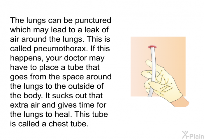 The lungs can be punctured which may lead to a leak of air around the lungs. This is called pneumothorax. If this happens, your doctor may have to place a tube that goes from the space around the lungs to the outside of the body. It sucks out that extra air and gives time for the lungs to heal. This tube is called a <I>chest tube</I>.
