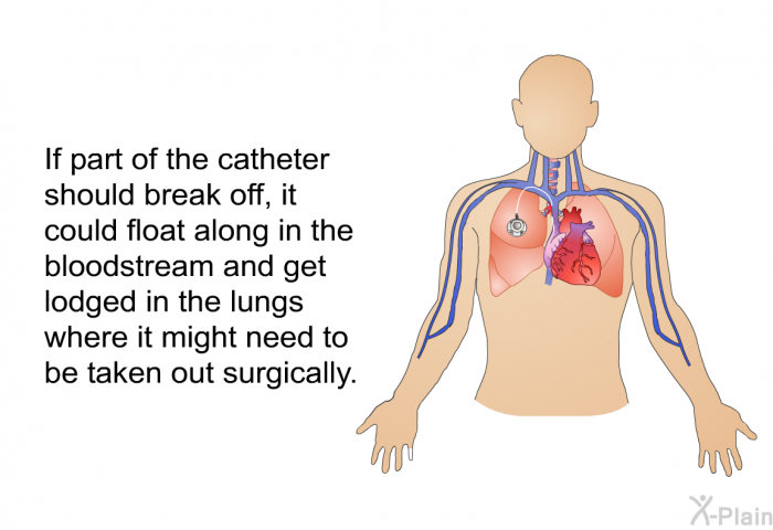 If part of the catheter should break off, it could float along in the bloodstream and get lodged in the lungs where it might need to be taken out surgically.