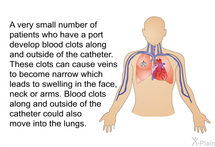A very small number of patients who have a port develop blood clots along and outside of the catheter. These clots can cause veins to become narrow which leads to swelling in the face, neck or arms. Blood clots along and outside of the catheter could also move into the lungs.