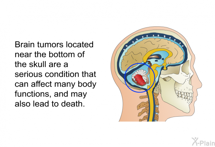 Brain tumors located near the bottom of the skull are a serious condition that can affect many body functions, and may also lead to death.