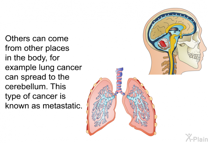 Others can come from other places in the body, for example lung cancer can spread to the cerebellum. This type of cancer is known as metastatic.