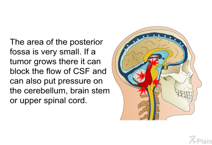 The area of the posterior fossa is very small. If a tumor grows there it can block the flow of CSF and can also put pressure on the cerebellum, brain stem or upper spinal cord.