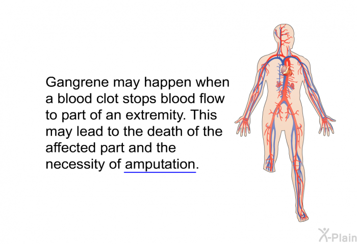 Gangrene may happen when a blood clot stops blood flow to part of an extremity. This may lead to the death of the affected part and the necessity of amputation.