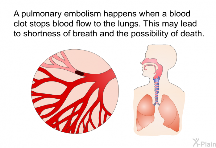 A pulmonary embolism happens when a blood clot stops blood flow to the lungs. This may lead to shortness of breath and the possibility of death.