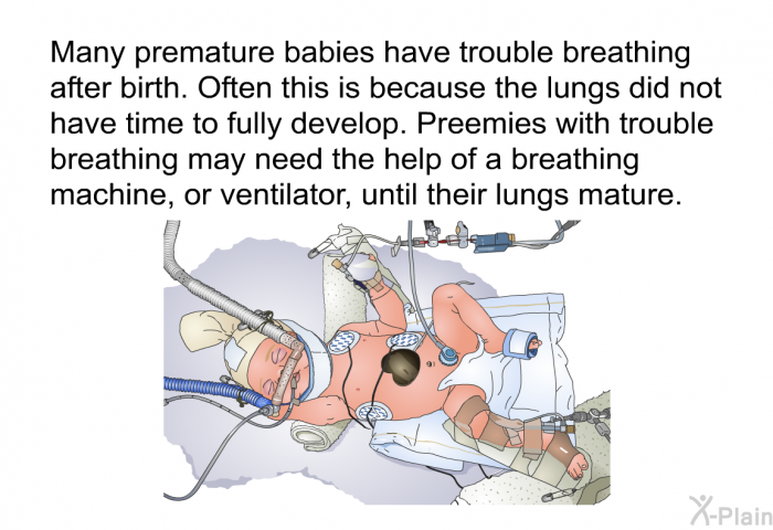 Many premature babies have trouble breathing after birth. Often this is because the lungs did not have time to fully develop. Preemies with trouble breathing may need the help of a breathing machine, or ventilator, until their lungs mature.